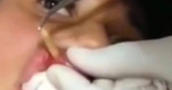Βίντεο για γερά στομάχια: Αφαίρεσαν προνύμφη εντόμου από τα… χείλη της!