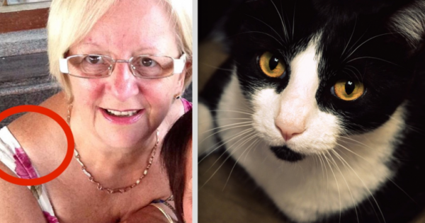 Αυτή η 64χρονη δεν είχε ιδέα τι μεγάλωνε στον ώμο της. Η γάτα της όμως κατάλαβε, ότι κάτι δεν πήγαινε καλά. (Εικόνες)
