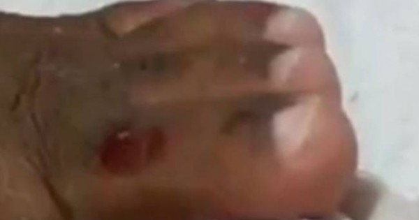 Τρομακτικό βίντεο: Μαζί με το νύχι του βγήκε και κάτι… ζωντανό!