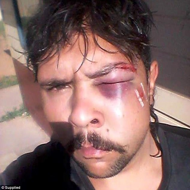 Κυνηγός προσπάθησε να σκοτώσει καγκουρό και το ζώο του επιτέθηκε και του βούλωσε το μάτι